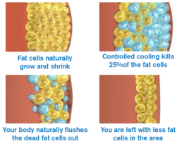 What is CoolSculpting?