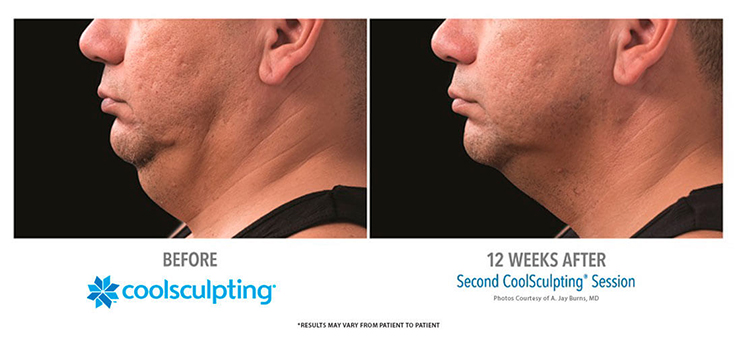 coolsculpting-under-chin-double-chin