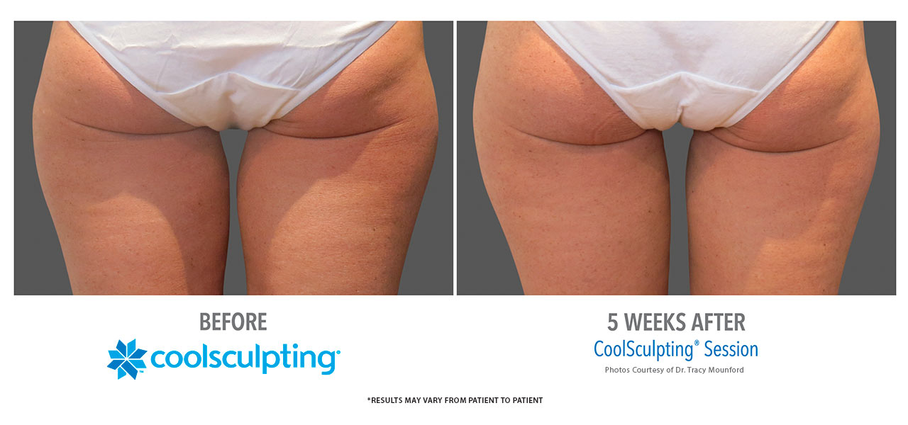 coolsculpting-outer-thighs-yucaipa-california