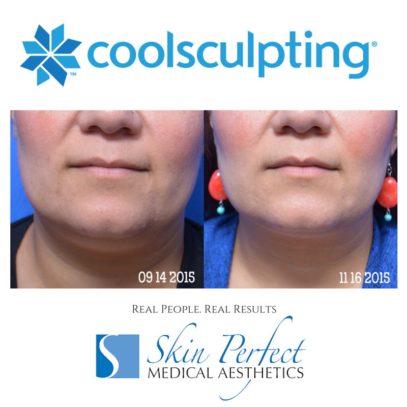Coolsculpting Under Chin Double Chin Reduction