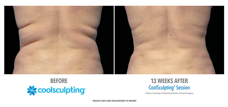 CoolSculpting Flanks Before and After, Whittier