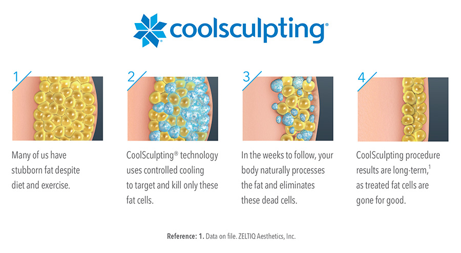 CoolSculpting Cell Illustration - Whittier, CA