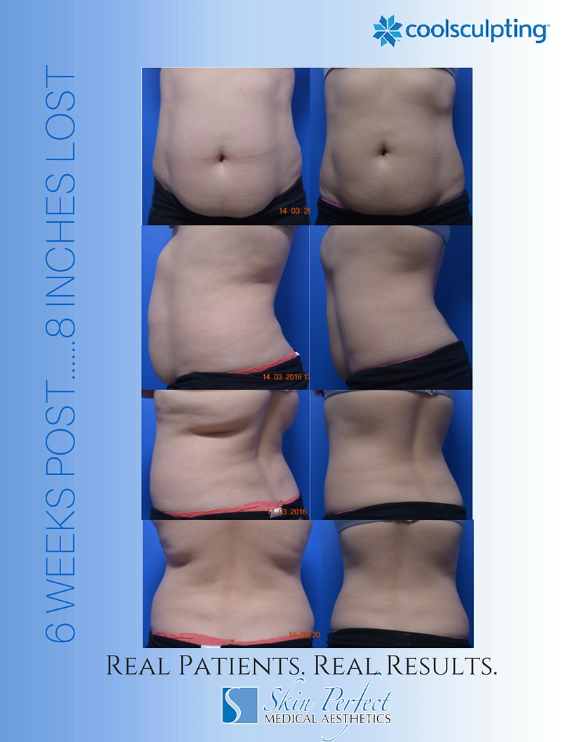 CoolSculpting - Whittier, CA
