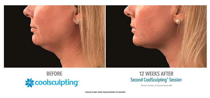 coolsculpting-double-chin-reduction