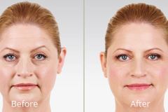 juvederm-before-after-madison-connecticut-aria-dermspa-dermatology-aesthetic-center-full-2