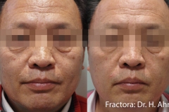 fractional1