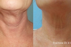 fractionalneck1