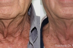 fractionalneck2