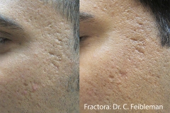 CF_Fractora_1a_LS_Acne CF_Fractora_1a_LS_Acne