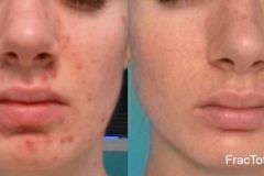 fractionalacne1 fractionalacne1