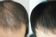 prp-hair-b-a-1024x395