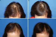 prp-hair-restoration-before-and-after-1
