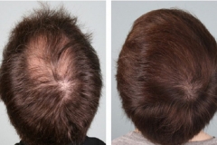 prp-hair-restoration-before-and-after-2-1024x577