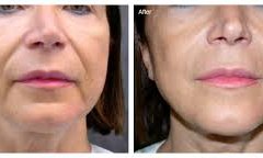 prp-skin-rejuvenation-before-and-after-4