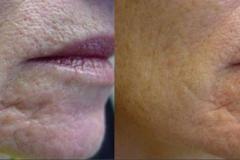 Laser-Genisis-San-Antonio-Scar-Reduction-TX